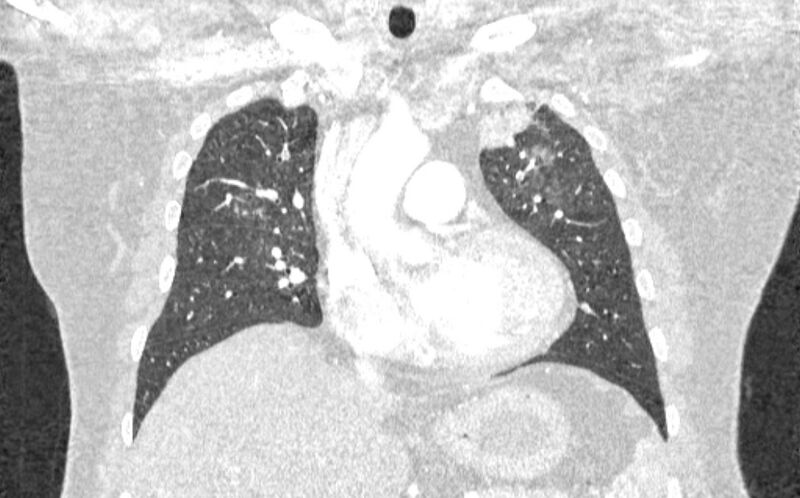 File:Acute pulmonary embolism with pulmonary infarcts (Radiopaedia 77688-89908 Coronal lung window 33).jpg