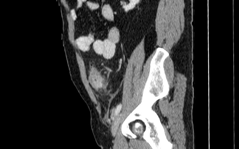 File:Acute sigmoid colon diverticulitis (Radiopaedia 55507-61976 Sagittal C+ portal venous phase 73).jpg