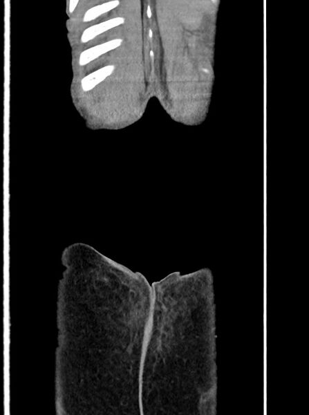 File:Acute small bowel (ileal) volvulus (Radiopaedia 71740-82139 Coronal C+ portal venous phase 111).jpg