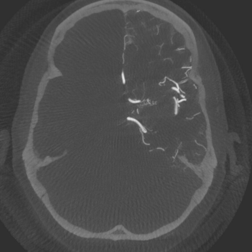 Acute subarachnoid hemorrhage and accessory anterior cerebral artery (Radiopaedia 69231-79010 C 24).jpg