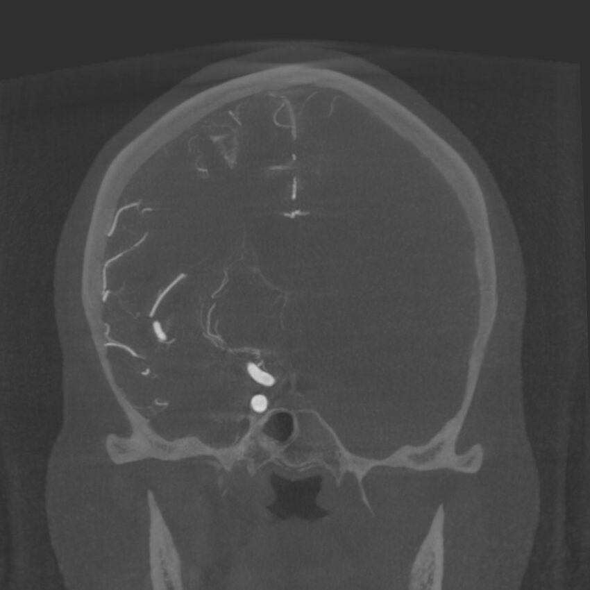 Acute subarachnoid hemorrhage and accessory anterior cerebral artery (Radiopaedia 69231-79010 Coronal arterial - MIP 46).jpg