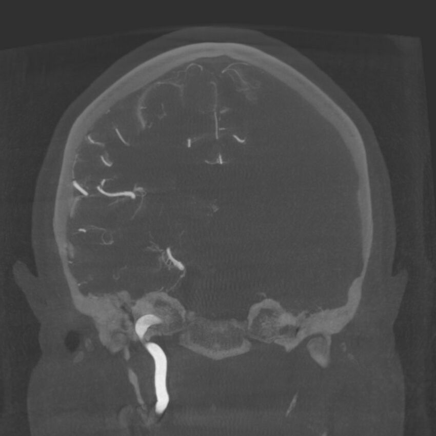 Acute subarachnoid hemorrhage and accessory anterior cerebral artery (Radiopaedia 69231-79010 Coronal arterial - MIP 58).jpg