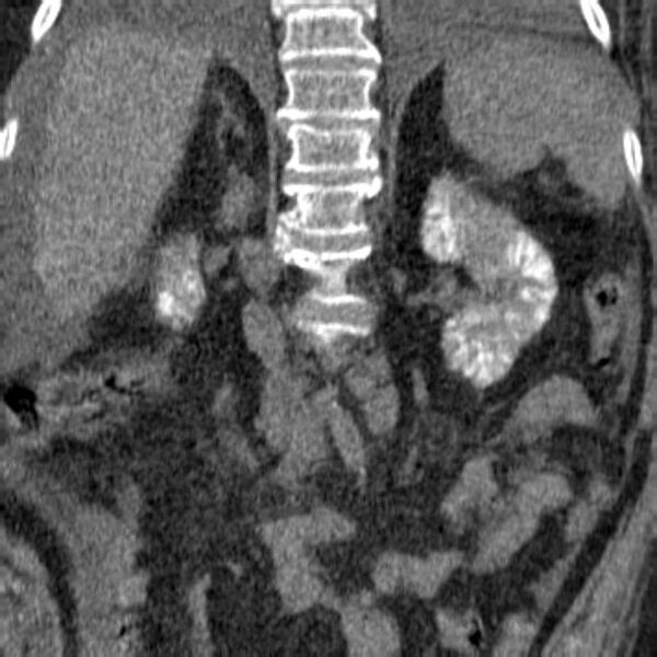 File:Acute tubular necrosis (Radiopaedia 28077-28334 Coronal non-contrast 9).jpg