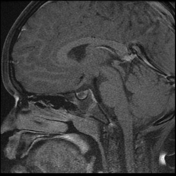 File:Adamantinomatous craniopharyngioma (Radiopaedia 77407-89529 Sagittal T1 C+ fat sat 7).jpg
