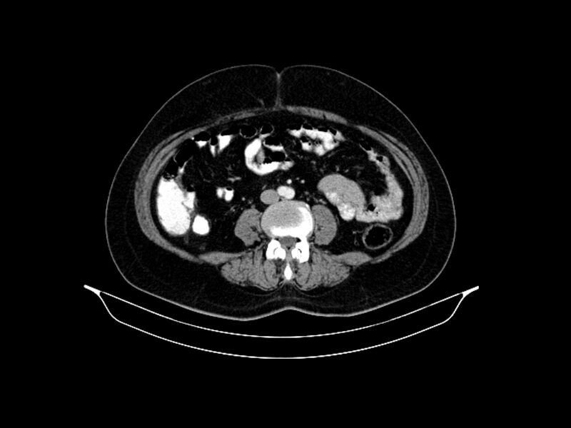 File:Adenocarcinoma of pancreas with hepatic metastasis (Radiopaedia 64332-73122 Axial C+ portal venous phase 61).jpg