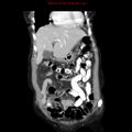 Adenocarcinoma of the colon (Radiopaedia 8191-9039 Coronal liver window 12).jpg