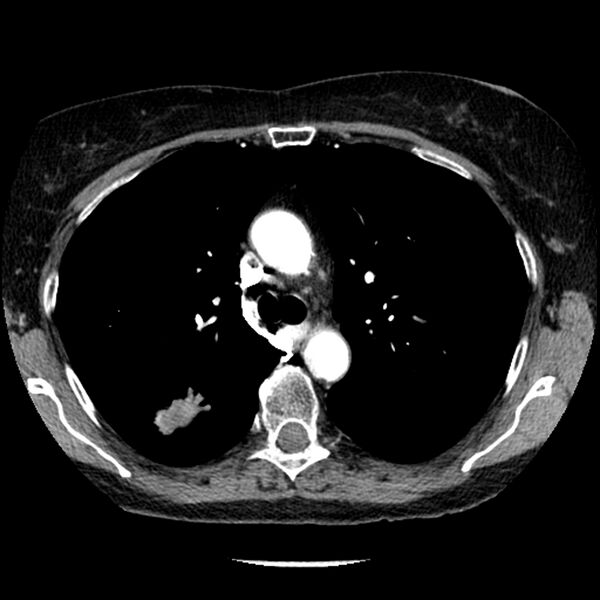 File:Adenocarcinoma of the lung (Radiopaedia 41015-43755 Axial C+ portal venous phase 42).jpg
