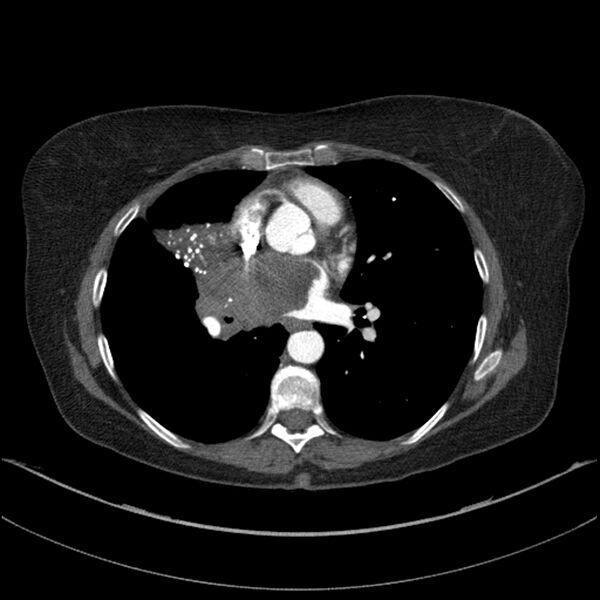 File:Adenocarcinoma of the lung (Radiopaedia 44205-47803 Axial C+ portal venous phase 48).jpg