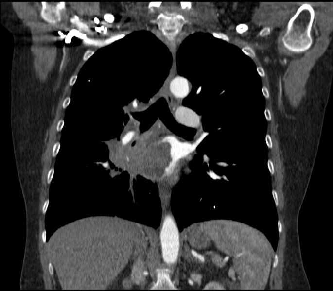 File:Adenocarcinoma of the lung (Radiopaedia 44205-47803 Coronal C+ portal venous phase 51).jpg