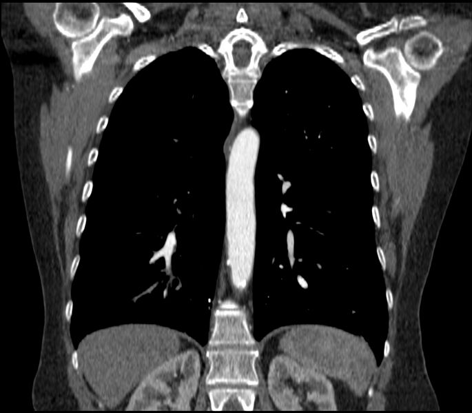 File:Adenocarcinoma of the lung (Radiopaedia 44205-47803 Coronal C+ portal venous phase 64).jpg