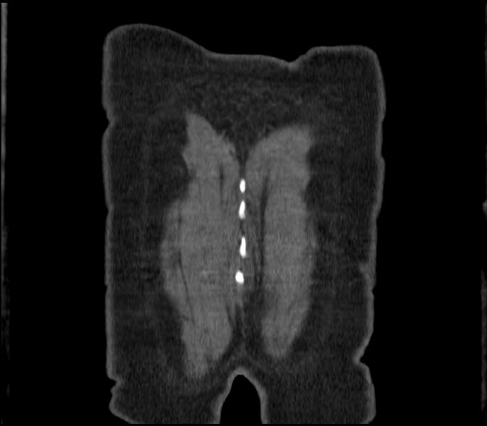 File:Adenocarcinoma of the lung (Radiopaedia 44205-47803 Coronal C+ portal venous phase 99).jpg