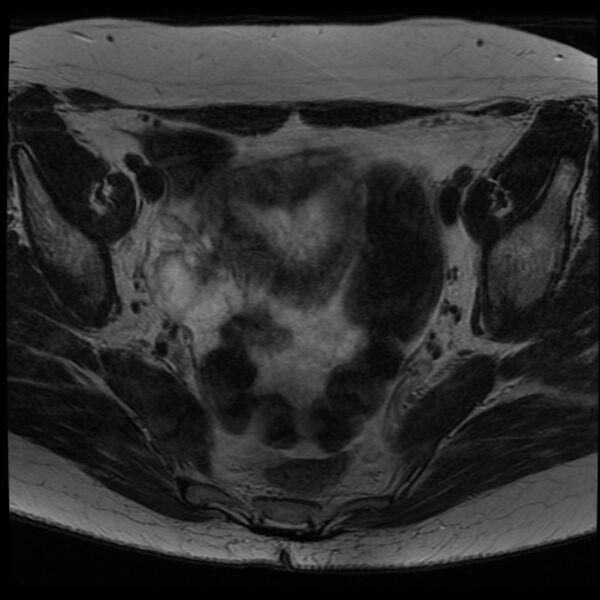 File:Adenoma malignum of the cervix (Radiopaedia 24460-24765 C 7).jpg