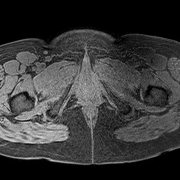 File:Adenomyoma of the uterus (Radiopaedia 9871-10439 Axial T1 fat sat 2).jpg
