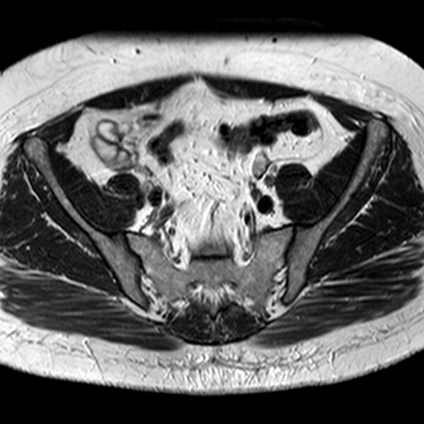 File:Adenomyoma of the uterus (Radiopaedia 9871-10439 Axial T2 25).jpg