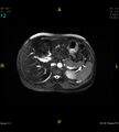 Adenomyosis (Radiopaedia 43504-46889 Axial 2D FIESTA 12).jpg