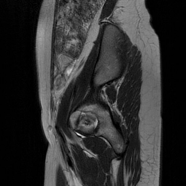 File:Adenomyosis within a septate uterus (Radiopaedia 69963-79981 Sagittal T2 3).jpg