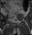Adnexal multilocular cyst (O-RADS US 3- O-RADS MRI 3) (Radiopaedia 87426-103754 Coronal 10).jpg