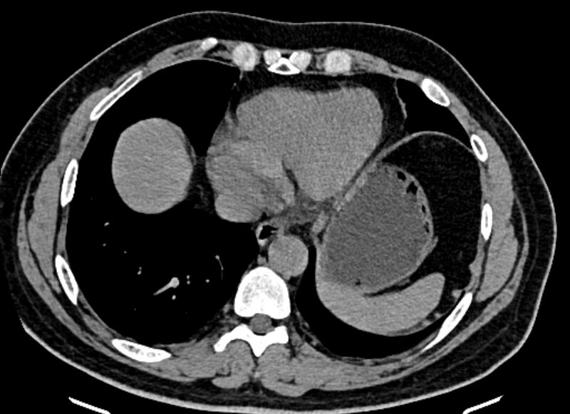 File:Adrenal metastases (Radiopaedia 73082-83791 Axial non-contrast 12).jpg