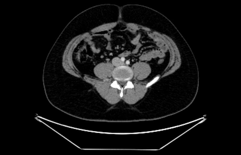 File:Adrenocortical carcinoma (Radiopaedia 80134-93438 Axial C+ portal venous phase 83).jpg