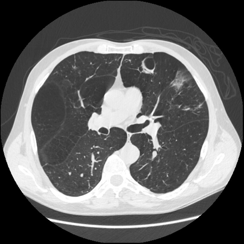 Alpha-1-antitrypsin deficiency (Radiopaedia 40993-43722 Axial lung window 109).jpg