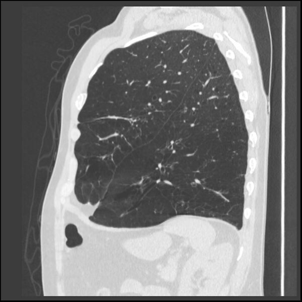 File:Alpha-1-antitrypsin deficiency (Radiopaedia 40993-43722 Sagittal lung window 69).jpg