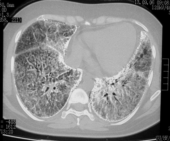 File:Alveolar microlithiasis (Radiopaedia 5310-7065 Axial lung window 1).jpg