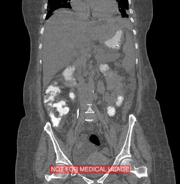 File:Amoebic enterocolitis with liver abscess (Radiopaedia 35100-36609 B 97).jpg