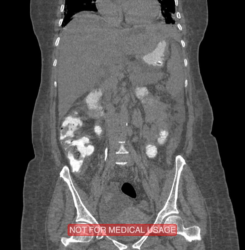 Amoebic enterocolitis with liver abscess (Radiopaedia 35100-36609 B 97).jpg