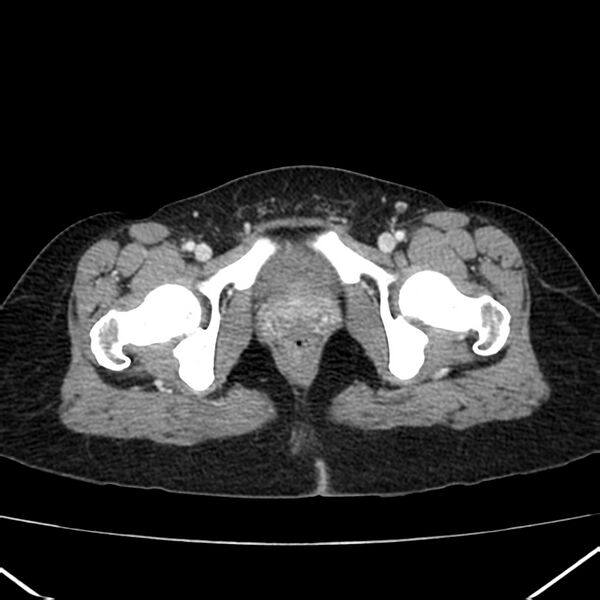 File:Ampullary tumor (Radiopaedia 22787-22816 C 69).jpg