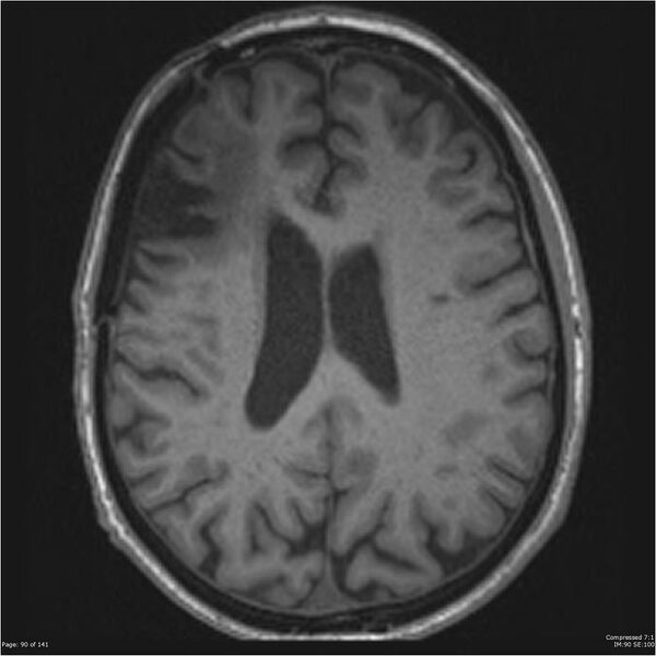 File:Anaplastic meningioma with recurrence (Radiopaedia 34452-35788 Axial T1 88).jpg