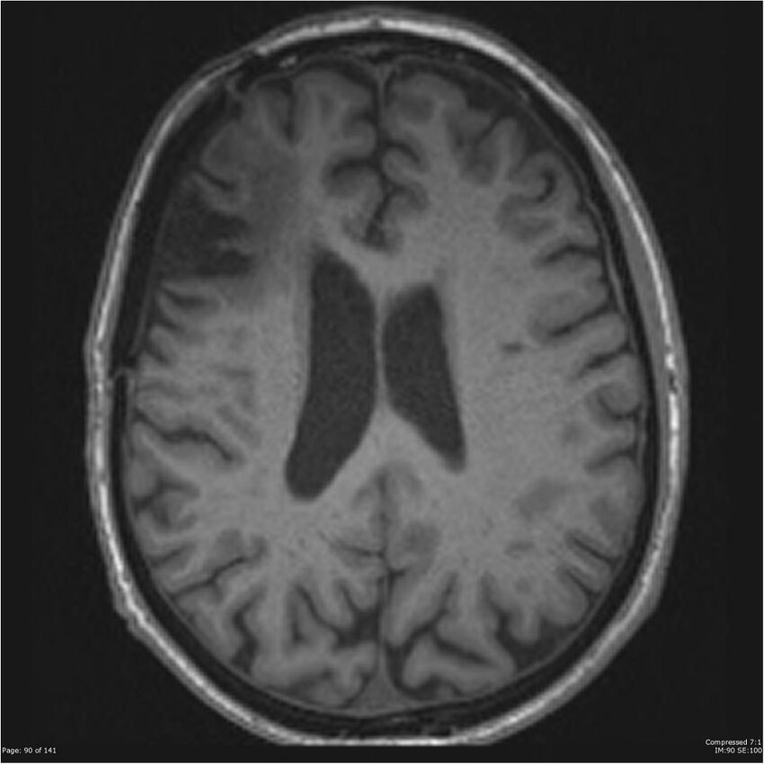 Anaplastic meningioma with recurrence (Radiopaedia 34452-35788 Axial T1 88).jpg