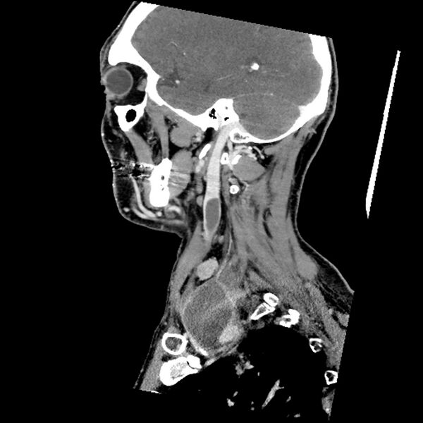File:Anaplastic thyroid carcinoma (Radiopaedia 79087-92034 C 29).jpg