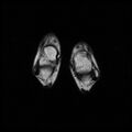 Aneurysmal bone cyst - tibia (Radiopaedia 22343-22367 Axial T2 19).jpg