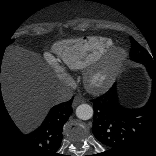 File:Anomalous origin of left circumflex artery from right coronary sinus (Radiopaedia 72563-83117 B 146).jpg