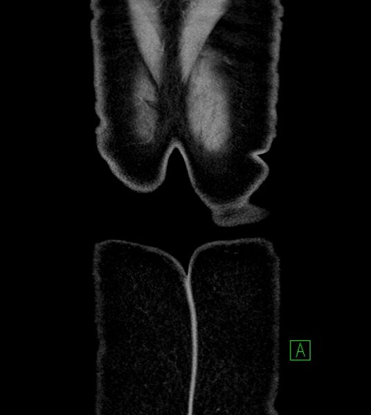 File:Anterior abdominal wall CSF pseudocyst (CSFoma) (Radiopaedia 79453-92571 B 56).jpg