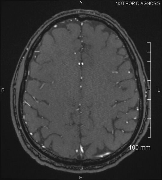 File:Anterior cerebral artery aneurysm (Radiopaedia 80683-94127 Axial MRA 184).jpg