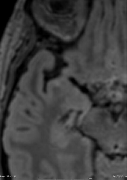 File:Anterior temporal lobe perivascular space (Radiopaedia 40946-43650 C 16).jpg