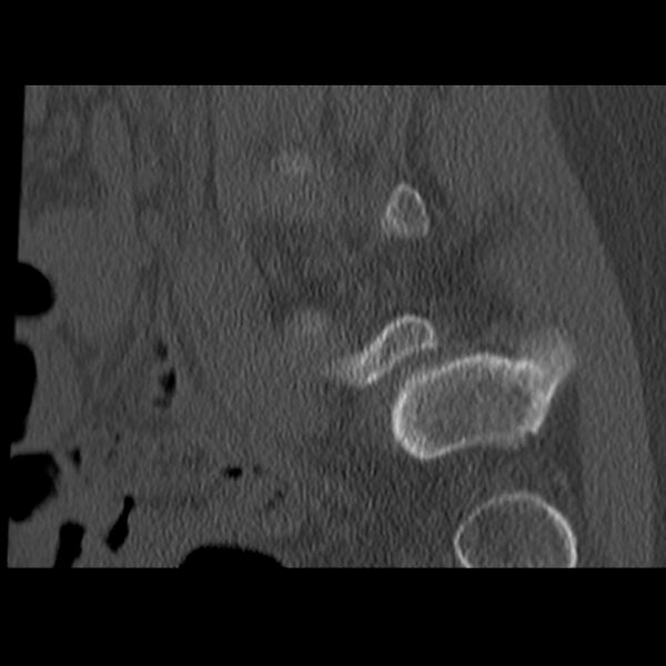 File:Anterolisthesis (Radiopaedia 22226-22263 Sagittal bone window 19).jpg
