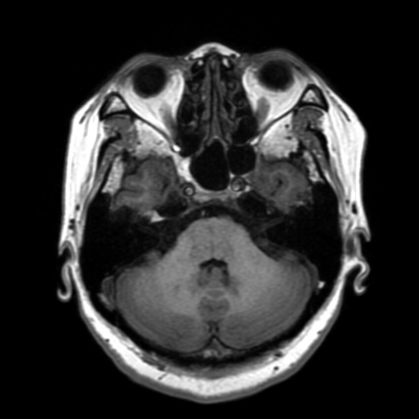 Anti-MOG encephalomyelitis (Radiopaedia 73831-84646 Axial T1 14).jpg