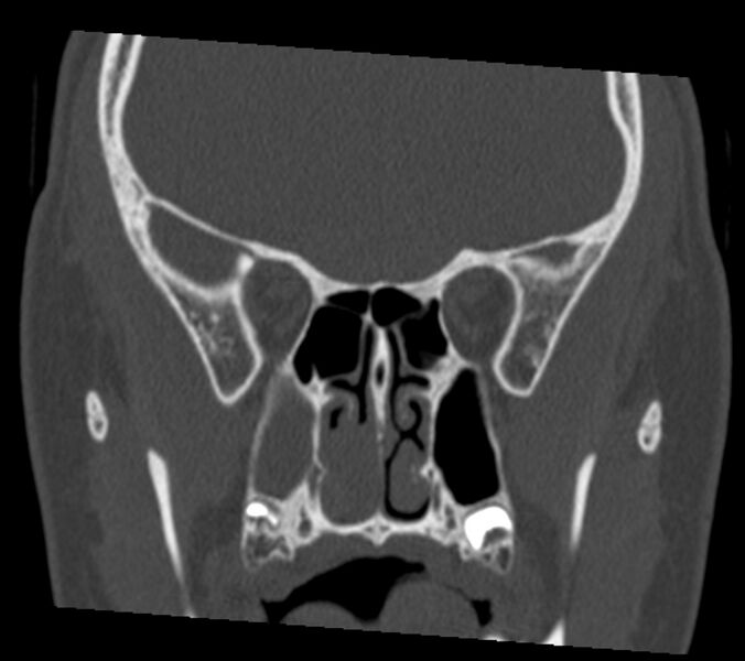 File:Antrochoanal polyp (Radiopaedia 21894-21868 Coronal bone window 21).jpg