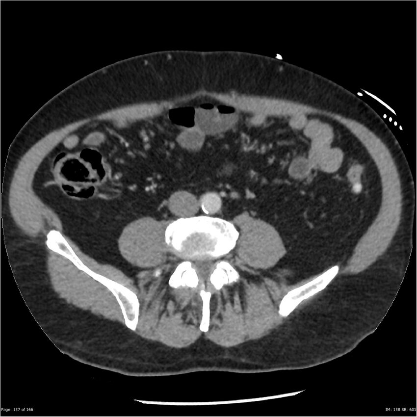 Aortic dissection- Stanford A (Radiopaedia 37759-39664 A 128).jpg