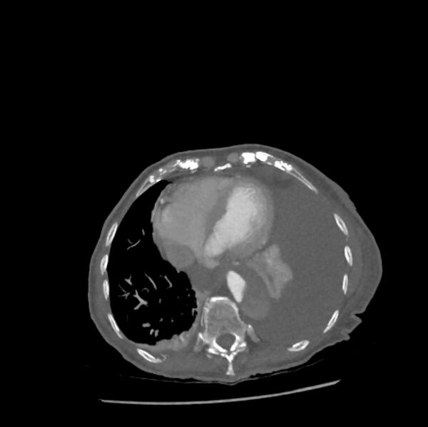 File:Aortic dissection (Radiopaedia 68763-78691 A 41).jpeg