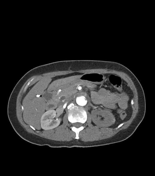 File:Aortic dissection with renal ischemia (Radiopaedia 76573-88338 A 66).jpg