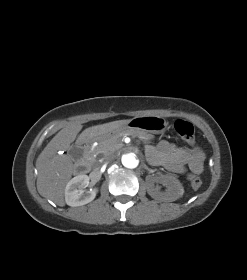 Aortic dissection with renal ischemia (Radiopaedia 76573-88338 A 66).jpg