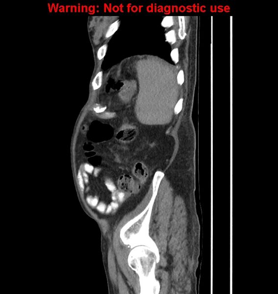 File:Aortic graft infection (Radiopaedia 44979-48907 C 13).jpg