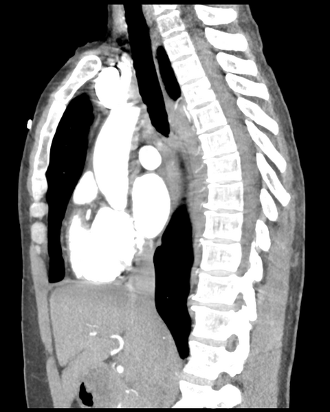 File:Aortic valve non-coronary cusp thrombus (Radiopaedia 55661-62189 D 29).png
