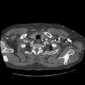 Aorto-coronary bypass graft aneurysms (Radiopaedia 40562-43157 A 13).png