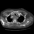 Aorto-coronary bypass graft aneurysms (Radiopaedia 40562-43157 A 21).png