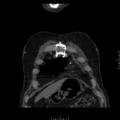 Aorto-coronary bypass graft aneurysms (Radiopaedia 40562-43157 B 3).png
