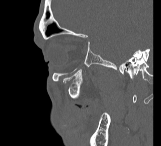 File:Aplastic maxillary sinuses (Radiopaedia 60030-67561 Sagittal bone window 25).jpg